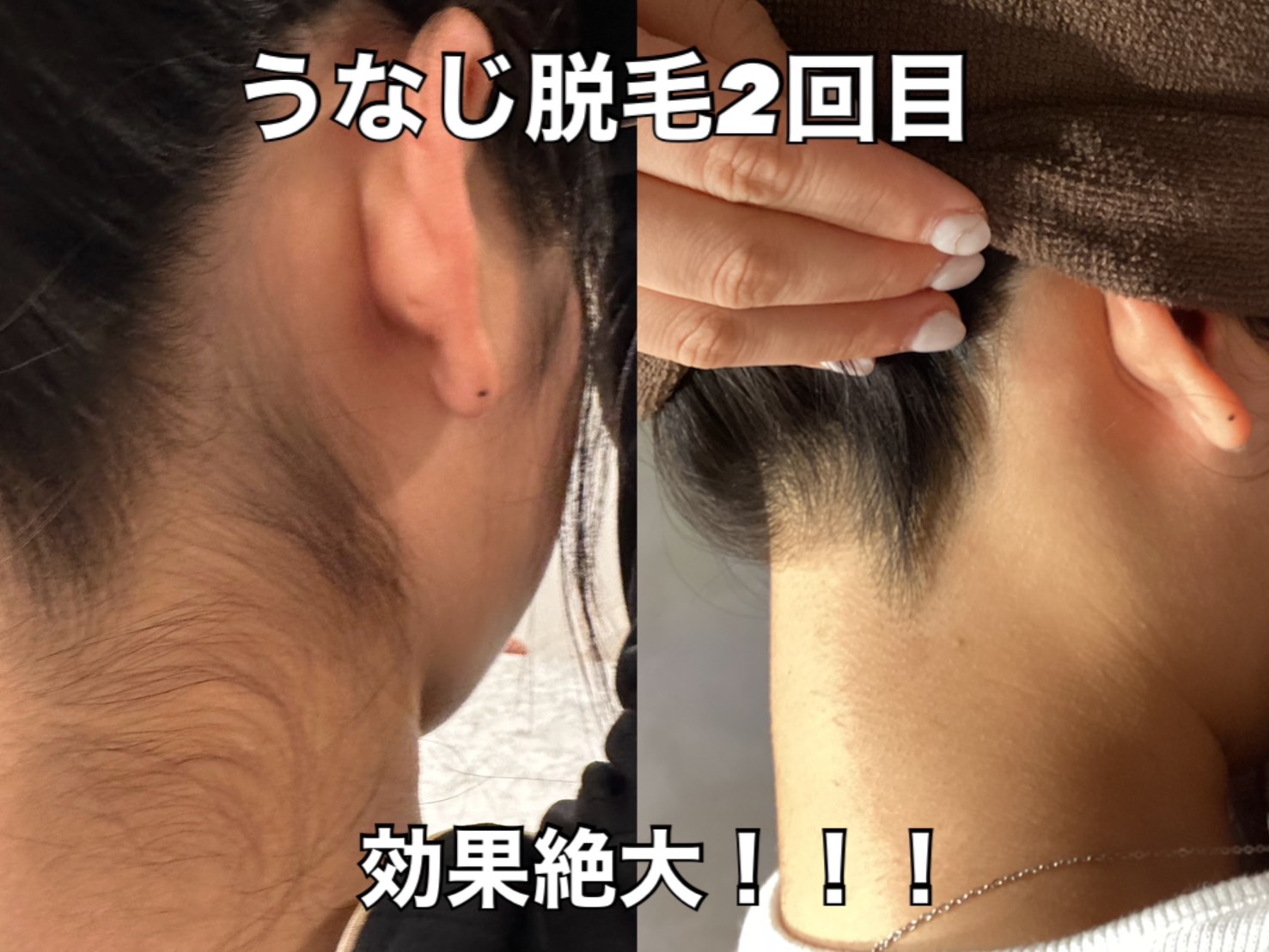 効果の高い脱毛に行きたい！
